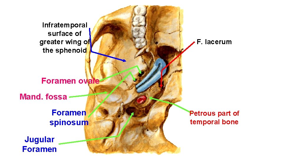 Infratemporal surface of greater wing of the sphenoid F. lacerum Foramen ovale Mand. fossa