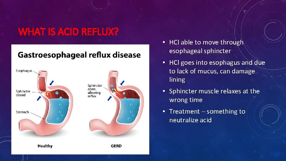 WHAT IS ACID REFLUX? • HCl able to move through esophageal sphincter • HCl
