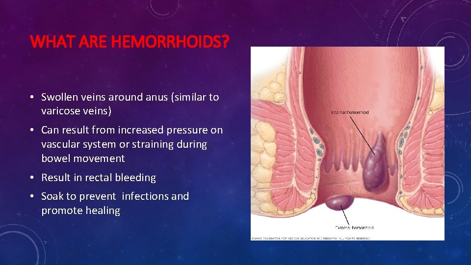 WHAT ARE HEMORRHOIDS? • Swollen veins around anus (similar to varicose veins) • Can