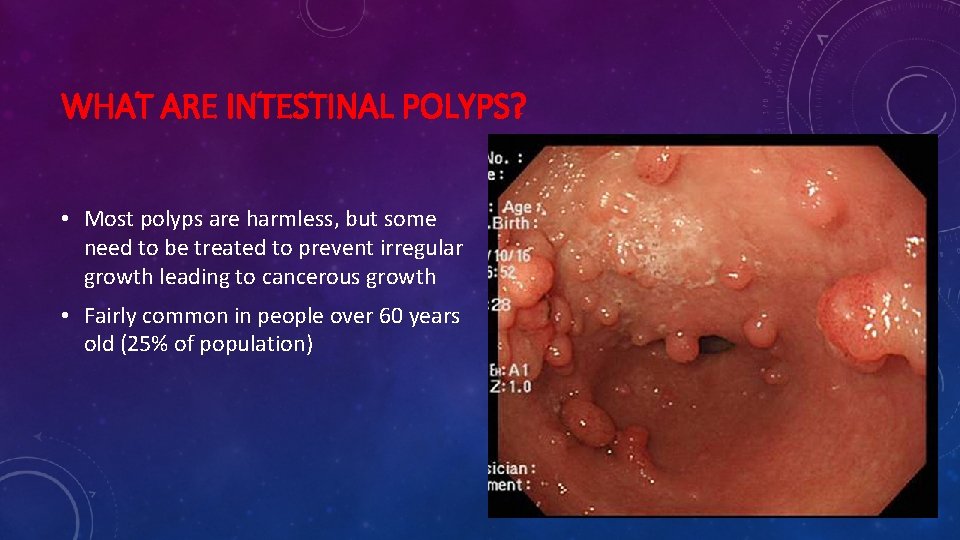 WHAT ARE INTESTINAL POLYPS? • Most polyps are harmless, but some need to be