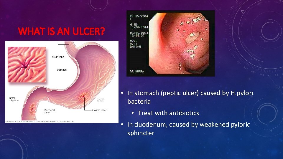 WHAT IS AN ULCER? • In stomach (peptic ulcer) caused by H. pylori bacteria