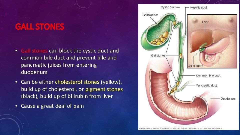 GALL STONES • Gall stones can block the cystic duct and common bile duct