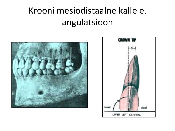 Krooni mesiodistaalne kalle e. angulatsioon 