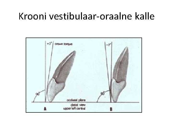 Krooni vestibulaar-oraalne kalle 