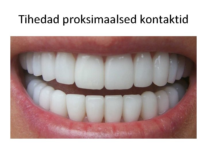 Tihedad proksimaalsed kontaktid 