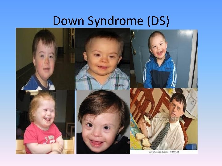 Down Syndrome (DS) 