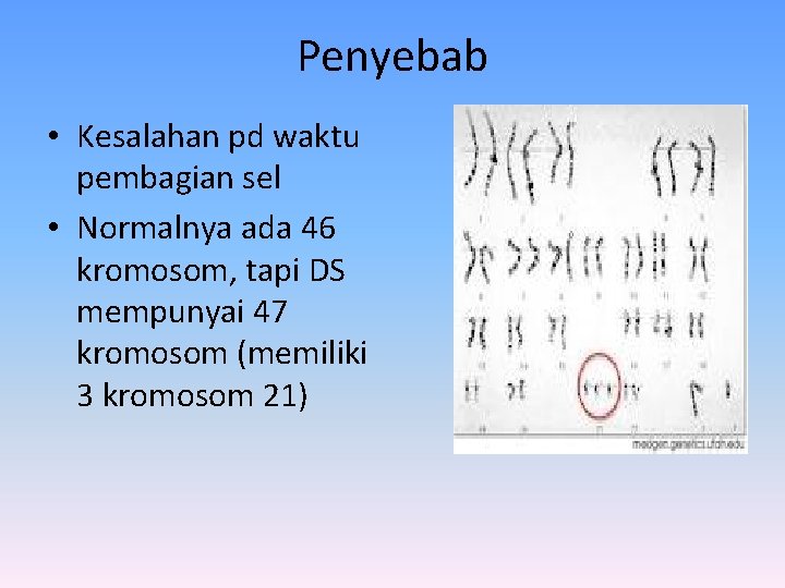 Penyebab • Kesalahan pd waktu pembagian sel • Normalnya ada 46 kromosom, tapi DS