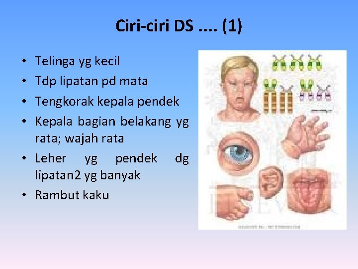 Ciri-ciri DS. . (1) Telinga yg kecil Tdp lipatan pd mata Tengkorak kepala pendek