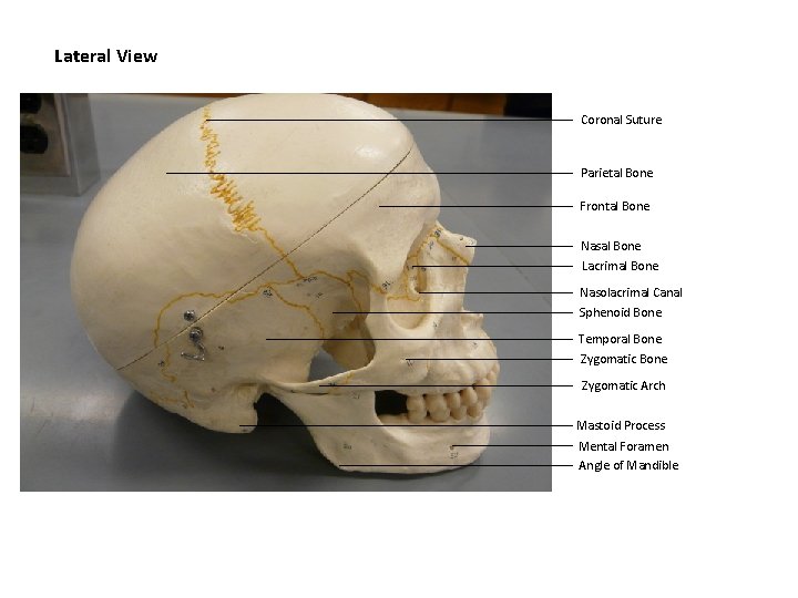 Lateral View Coronal Suture Parietal Bone Frontal Bone Nasal Bone Lacrimal Bone Nasolacrimal Canal