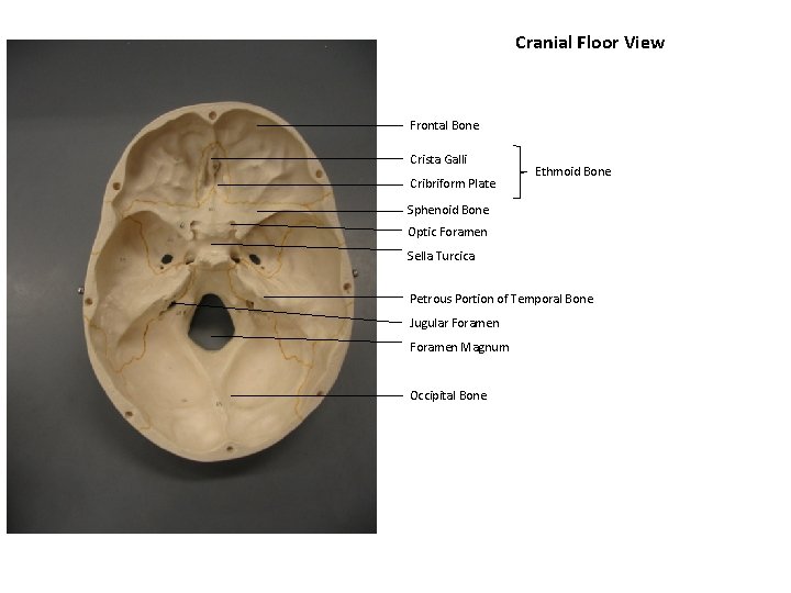Cranial Floor View Frontal Bone Crista Galli Cribriform Plate Ethmoid Bone Sphenoid Bone Optic