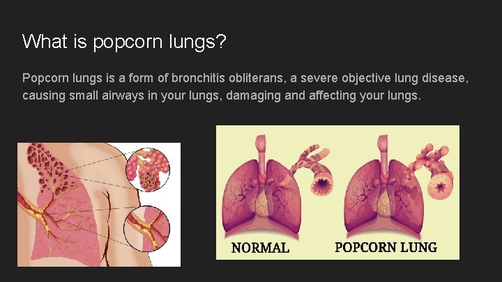 What is popcorn lungs? Popcorn lungs is a form of bronchitis obliterans, a severe