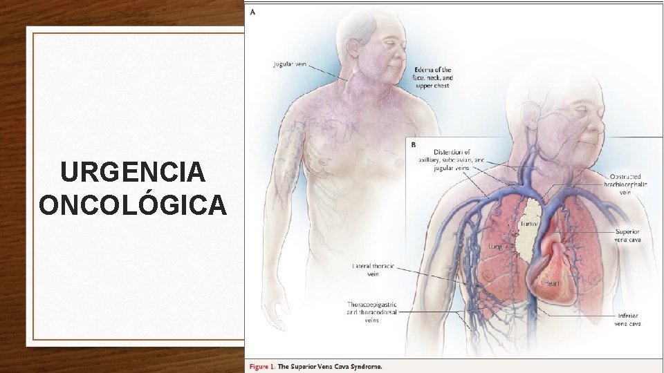 URGENCIA ONCOLÓGICA 