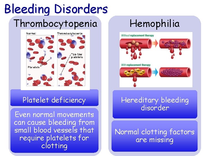 Bleeding Disorders Thrombocytopenia Hemophilia Platelet deficiency Hereditary bleeding disorder Even normal movements can cause