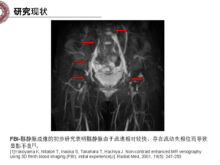 研究现状 FBI-髂静脉成像的初步研究表明髂静脉由于流速相对较快、存在流动失相位而导致 显影不良[1]。 [1]Yokoyama K, Nitatori T, Inaoka S, Takahara T, Hachiya J. Non-contrast