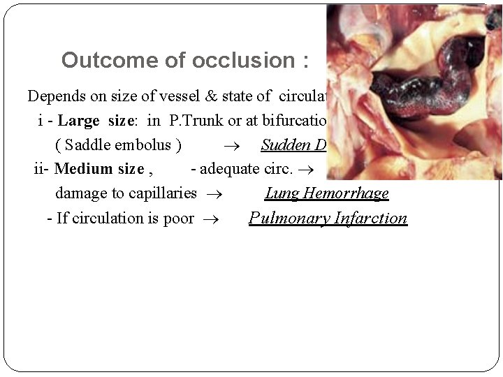 Outcome of occlusion : Depends on size of vessel & state of circulation i