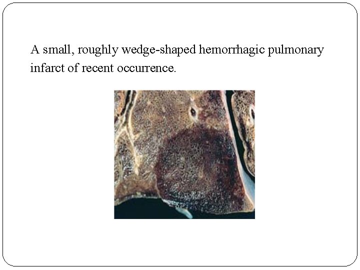 A small, roughly wedge-shaped hemorrhagic pulmonary infarct of recent occurrence. 