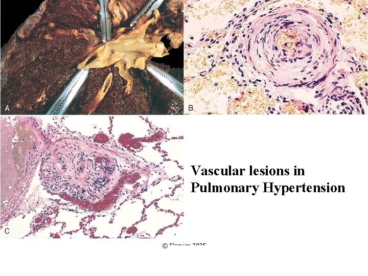 Vascular lesions in Pulmonary Hypertension 
