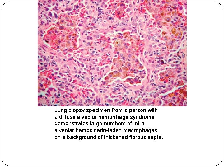 Lung biopsy specimen from a person with a diffuse alveolar hemorrhage syndrome demonstrates large