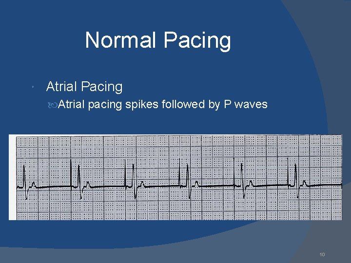 Normal Pacing Atrial Pacing Atrial pacing spikes followed by P waves 10 