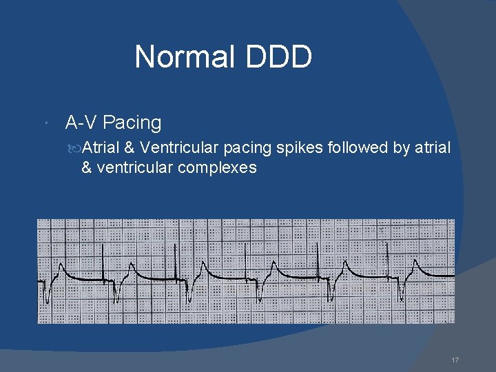 Normal DDD A-V Pacing Atrial & Ventricular pacing spikes followed by atrial & ventricular