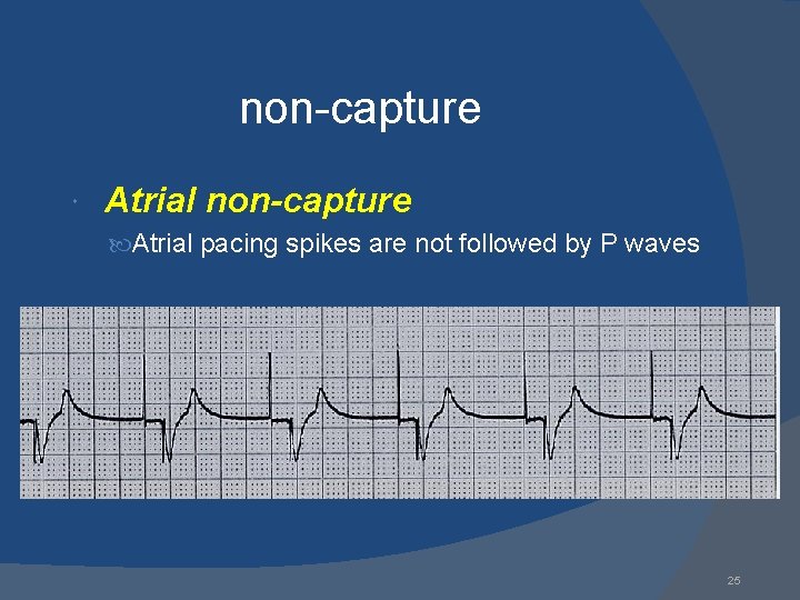 non-capture Atrial non-capture Atrial pacing spikes are not followed by P waves 25 