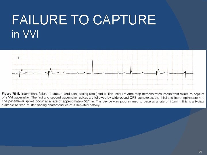 FAILURE TO CAPTURE in VVI 26 