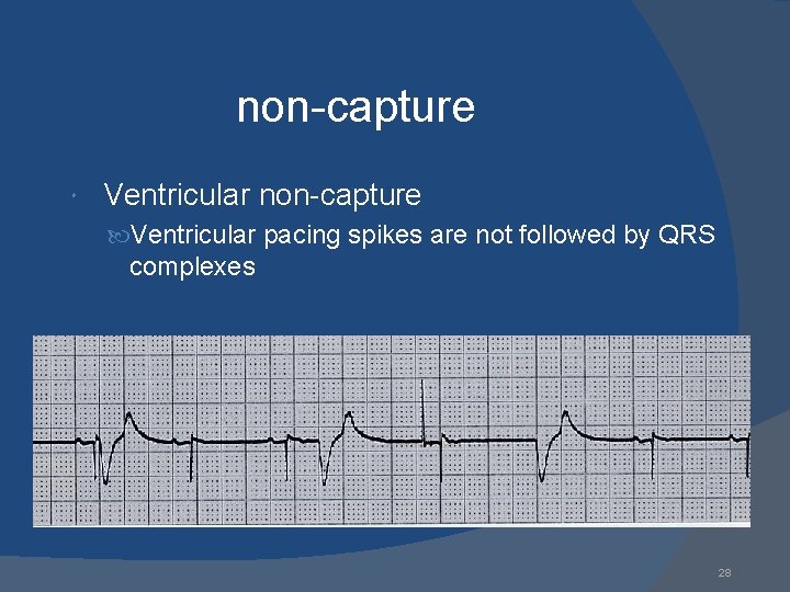 non-capture Ventricular non-capture Ventricular pacing spikes are not followed by QRS complexes 28 