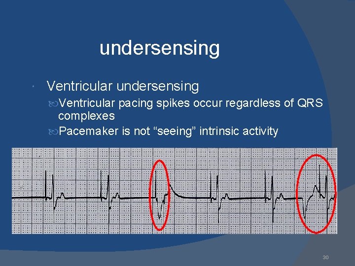 undersensing Ventricular undersensing Ventricular pacing spikes occur regardless of QRS complexes Pacemaker is not