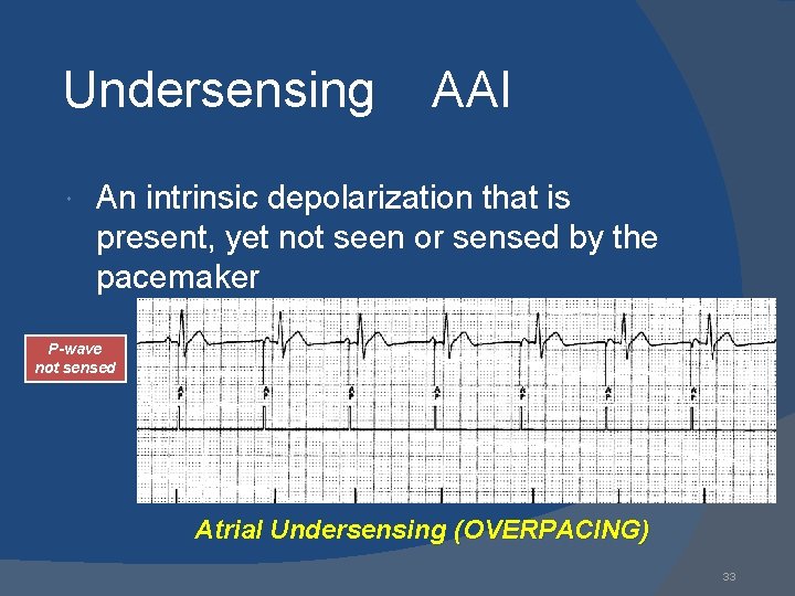 Undersensing AAI An intrinsic depolarization that is present, yet not seen or sensed by