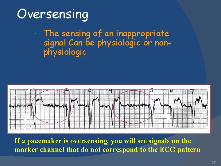 Oversensing The sensing of an inappropriate signal Can be physiologic or nonphysiologic If a