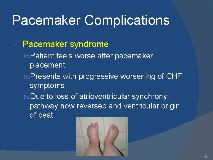 Pacemaker Complications Pacemaker syndrome Patient feels worse after pacemaker placement Presents with progressive worsening