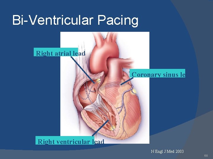 Bi-Ventricular Pacing Right atrial lead Coronary sinus lead Right ventricular lead N Engl J