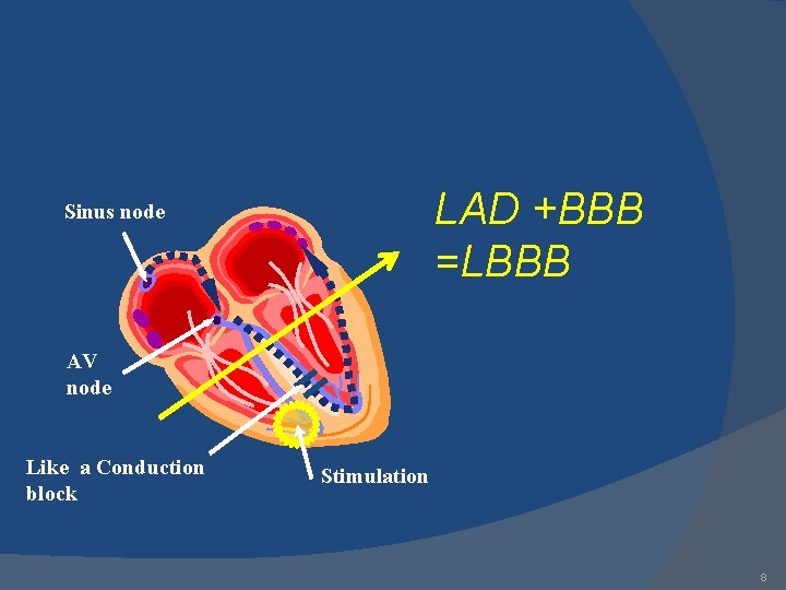 LAD +BBB =LBBB Sinus node AV node Like a Conduction block Stimulation 8 