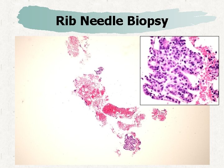 Rib Needle Biopsy 