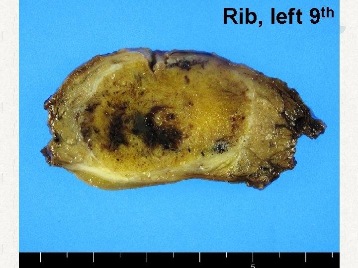 Rib, left th 9 