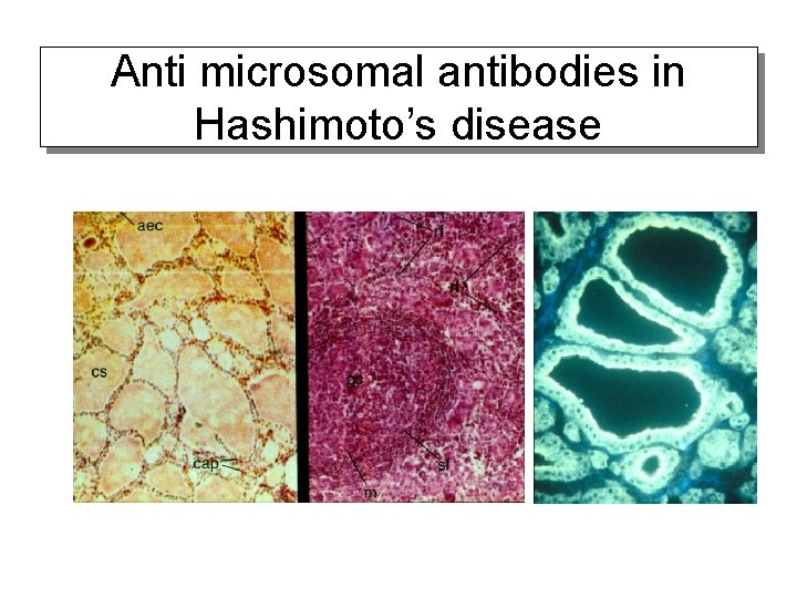 Anti microsomal antibodies in Hashimoto’s disease 