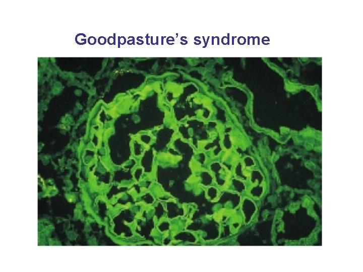 Goodpasture’s syndrome 