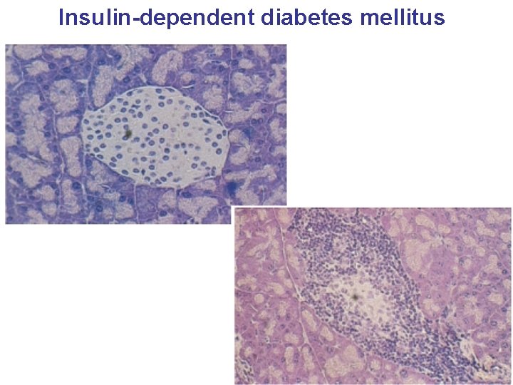 Insulin-dependent diabetes mellitus 