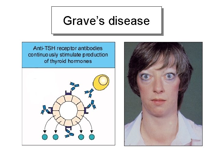 Grave’s disease 