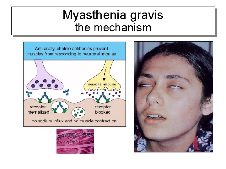 Myasthenia gravis the mechanism 
