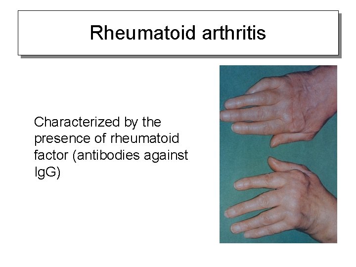 Rheumatoid arthritis Characterized by the presence of rheumatoid factor (antibodies against Ig. G) 