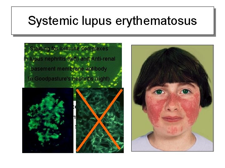 Systemic lupus erythematosus Staining for immune complexes in lupus nephritis (left) and Anti-renal basement