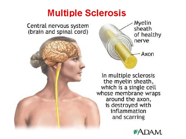 Multiple Sclerosis 
