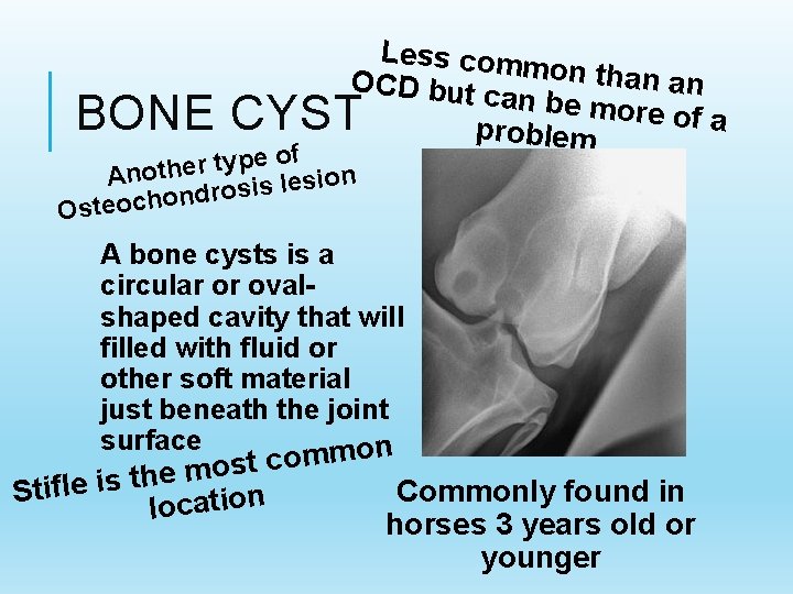 BONE Less comm on than an OCD but c an be mor e of