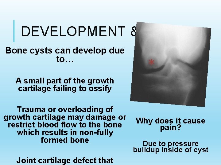 DEVELOPMENT & PAIN Bone cysts can develop due to… A small part of the