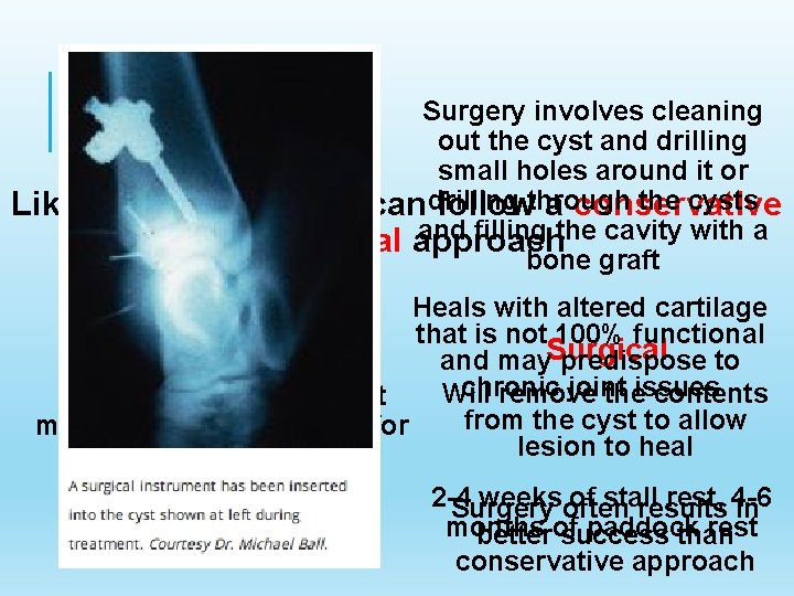 TREATMENT Like OCDs, Surgery involves cleaning out the cyst and drilling small holes around