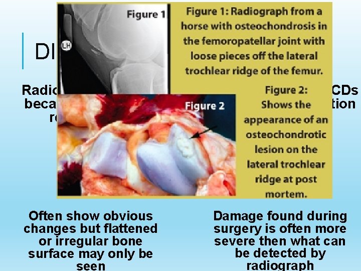 DIAGNOSIS Radiographs are the best diagnostic tool for OCDs because they provide the most