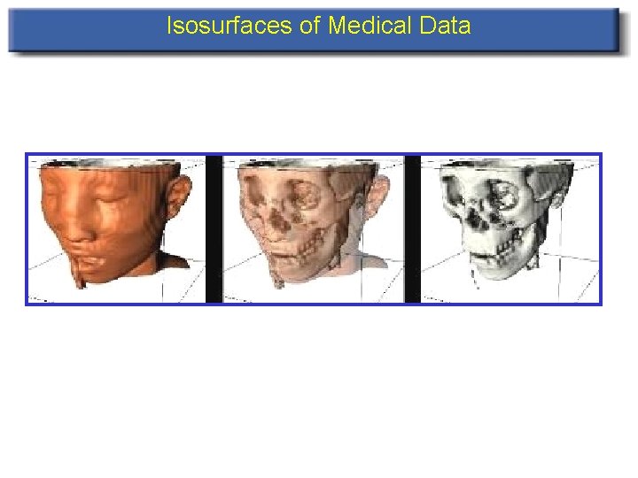 Isosurfaces of Medical Data 