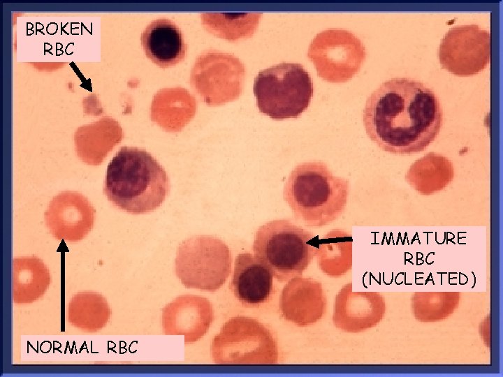 BROKEN RBC IMMATURE RBC (NUCLEATED) NORMAL RBC 