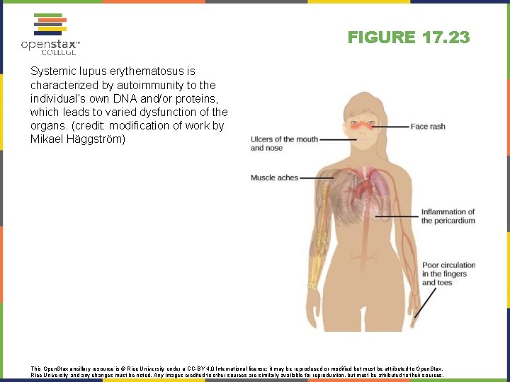 FIGURE 17. 23 Systemic lupus erythematosus is characterized by autoimmunity to the individual’s own